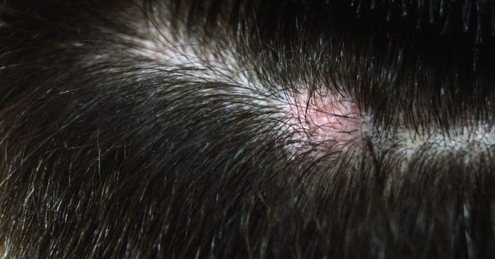 Hiểu đúng về tình trạng da đầu nhạy cảm