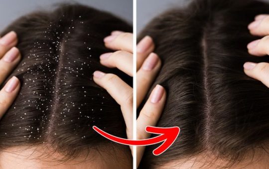 Lời khuyên vàng để phòng ngừa gàu quay trở lại