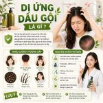 Di-ung-dau-goi-Nhan-biet-cach-xu-ly-va-bi-quyet-bao-ve-da-dau-khoe-manh-01